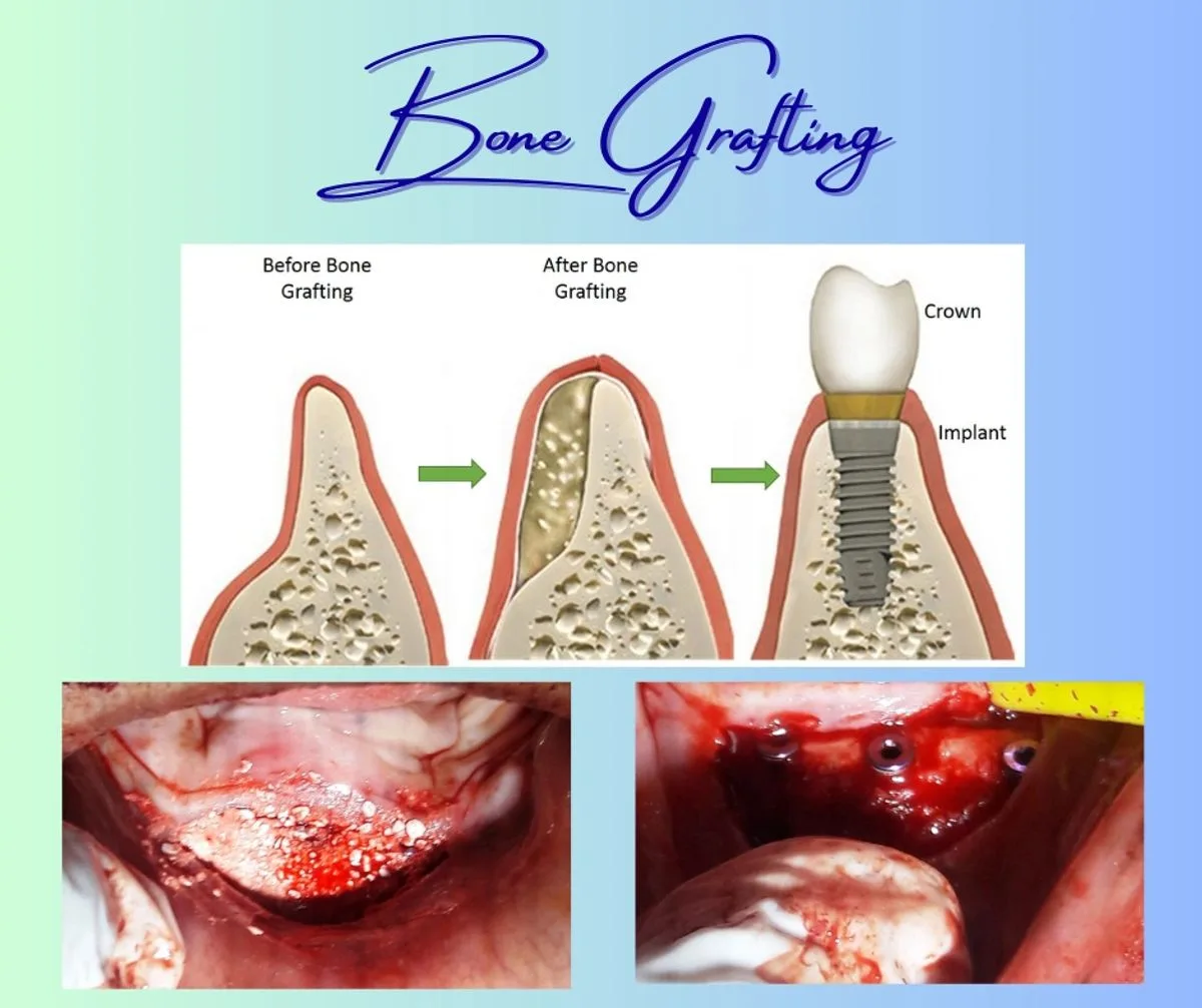 Bone grafting procedure diagram showing before and after grafting with implant placement
