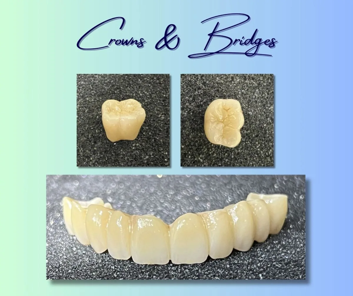 Zirconia dental crowns and a bridge restoration