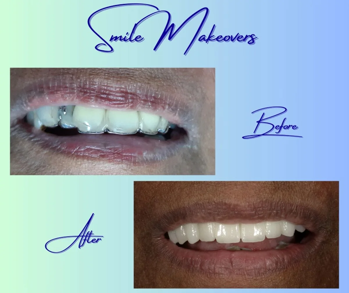 Before and after digital smile makeover
