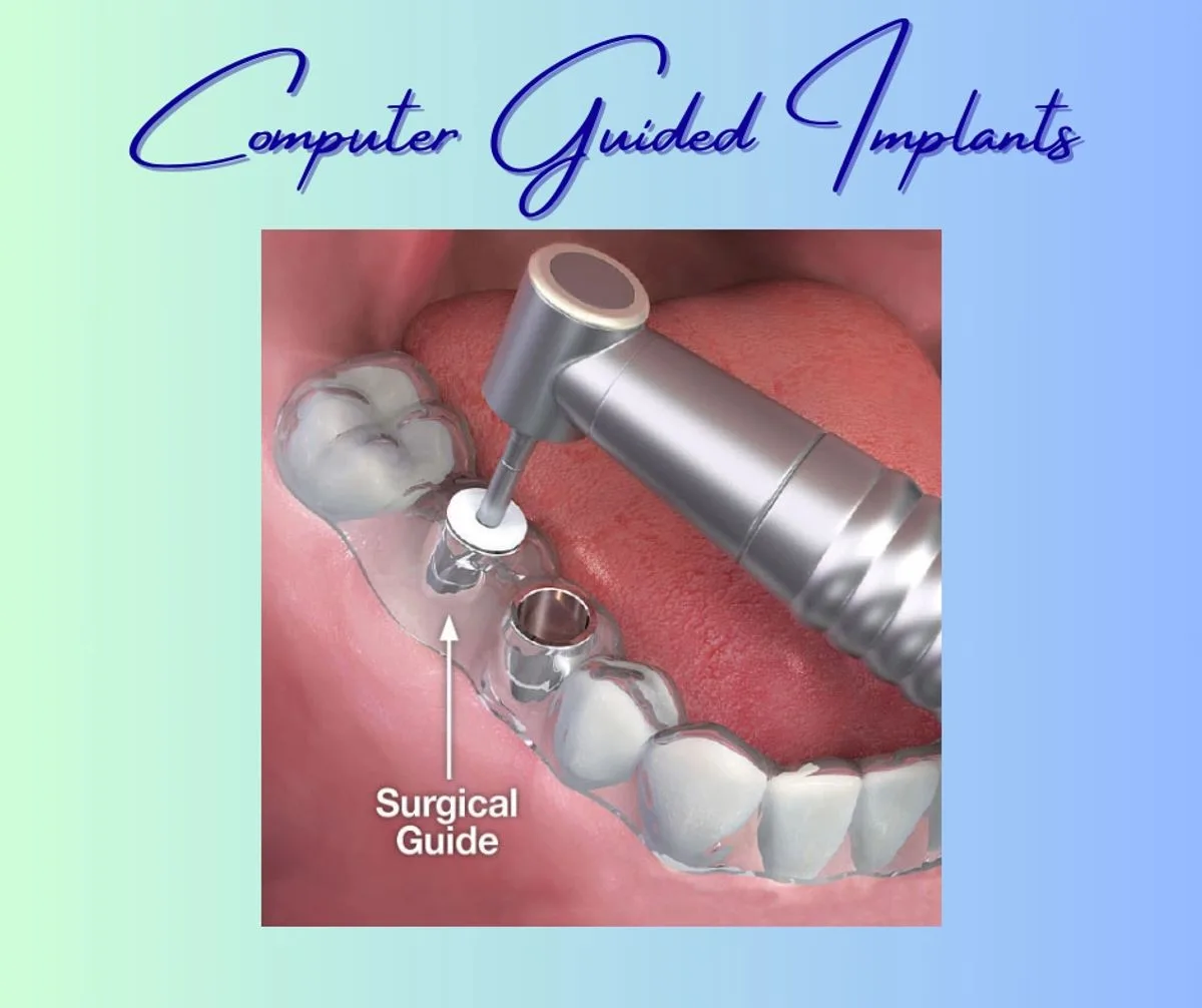 Computer guided dental implant surgery using a surgical guide