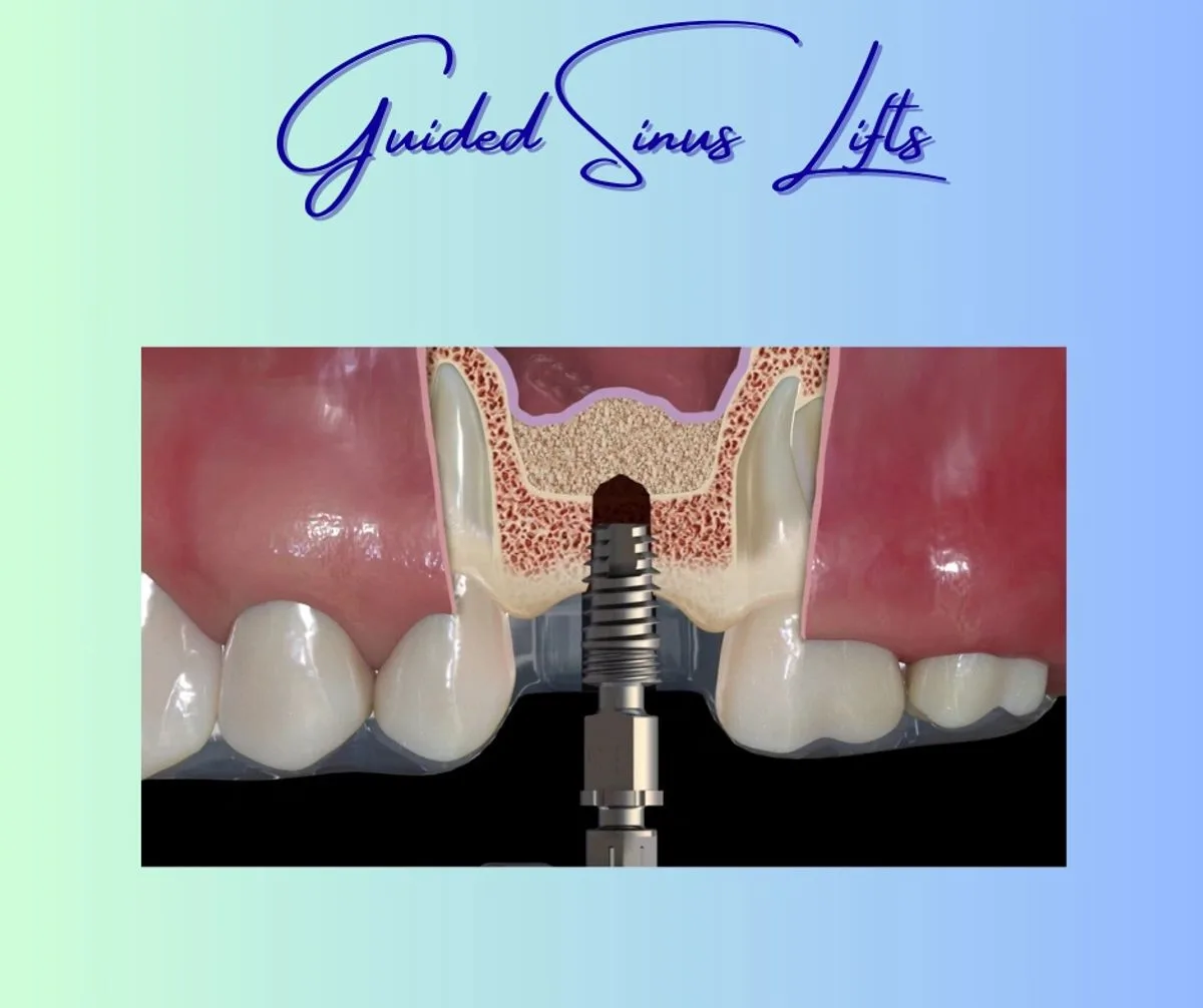 Guided sinus lift procedure with dental implant placement diagram