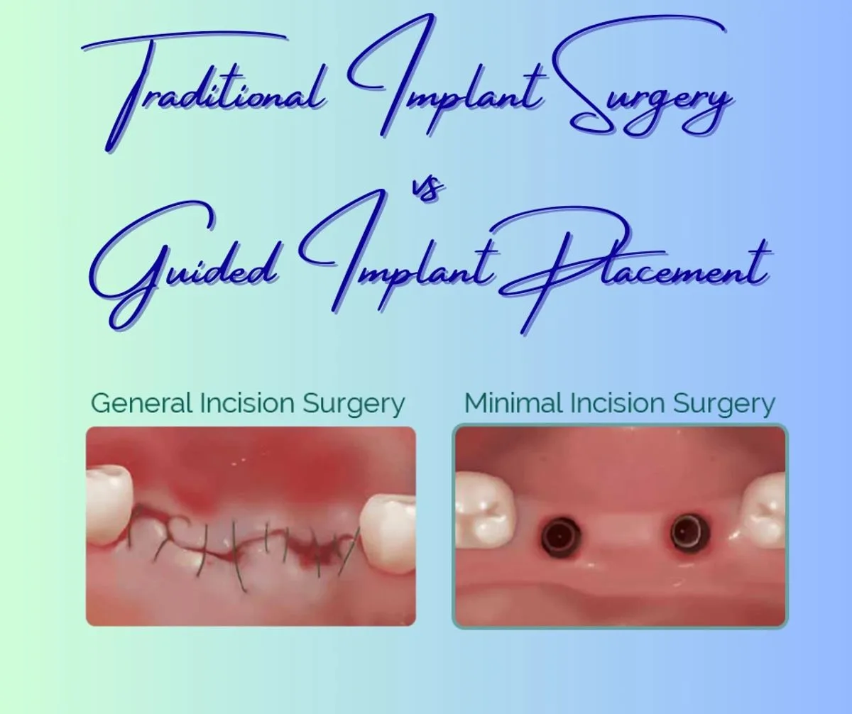 Comparison of traditional general incision surgery and minimal incision guided implant surgery