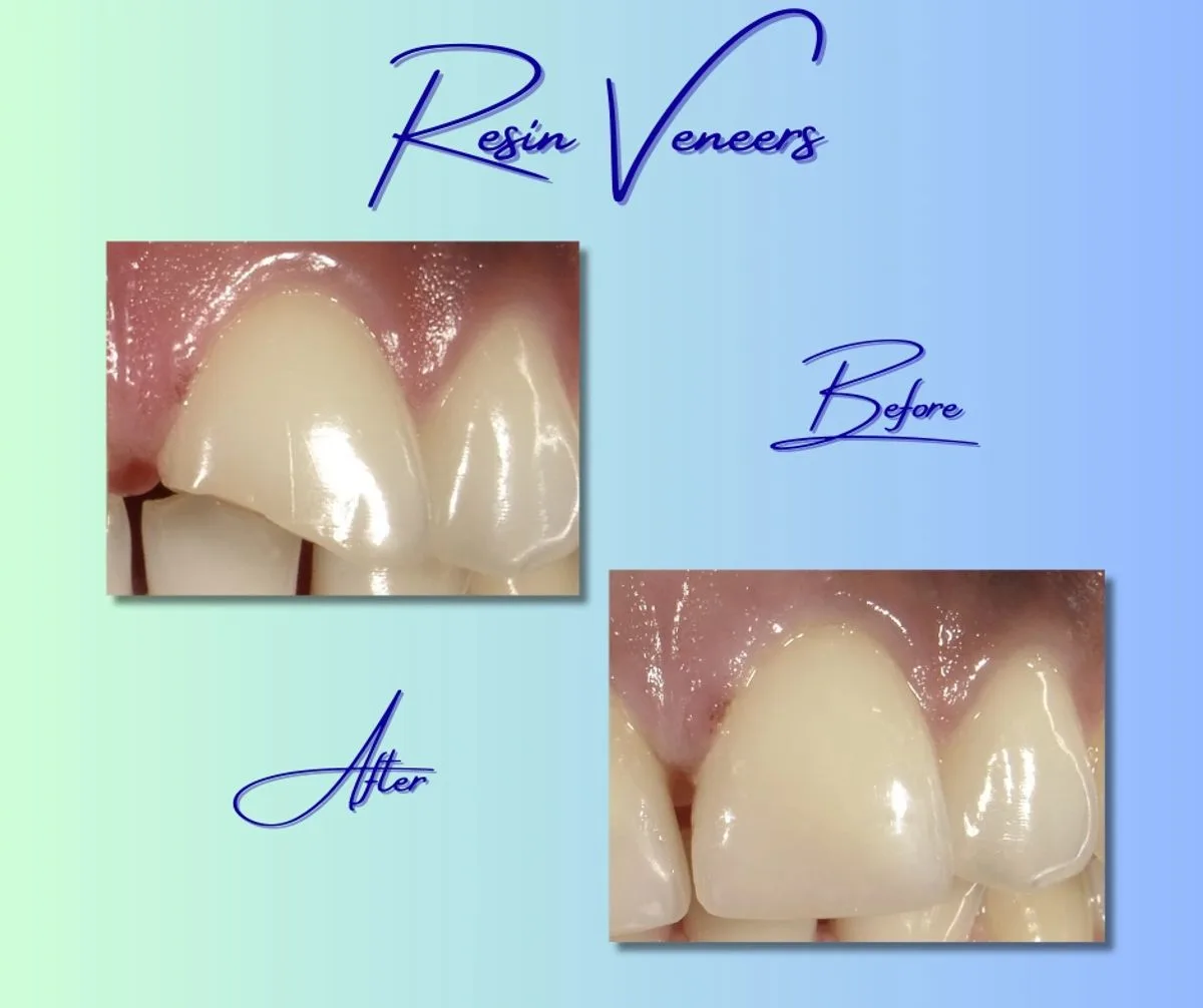 Before and after resin veneer restoration