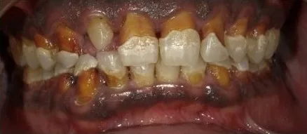 Cosmetic case 1 before treatment