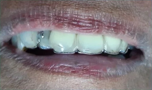 Cosmetic case 2 before treatment