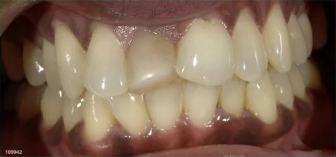 Cosmetic case 3 before treatment