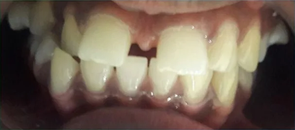 Cosmetic case 4 before treatment