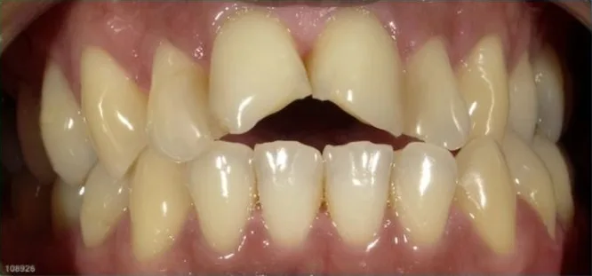 Smile transformation by Dr. Lalla before