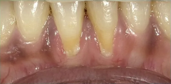 Cosmetic case 10 before treatment