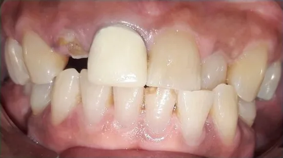 Cosmetic case 14 before treatment