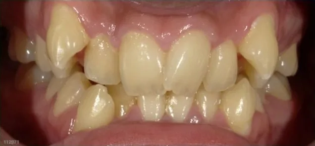 Fastbraces case 1 before treatment