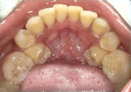 Fastbraces case 2 before treatment