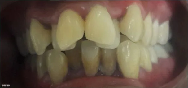 Smile transformation by Dr. Lalla before