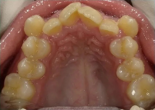 Fastbraces case 4 before treatment