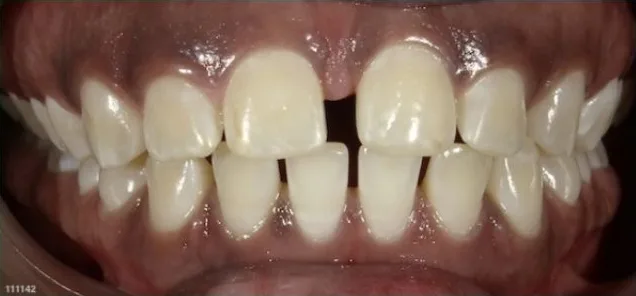 Fastbraces case 5 before treatment