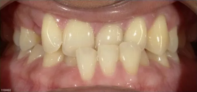 Fastbraces case 6 before treatment