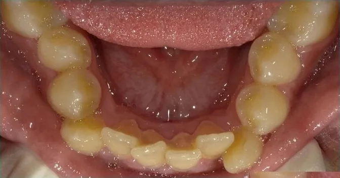Fastbraces case 7 before treatment
