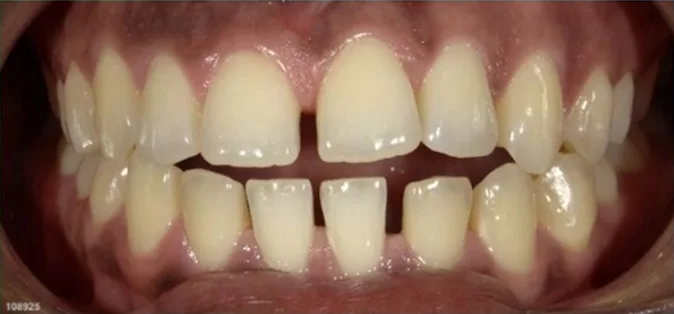 Fastbraces case 8 before treatment