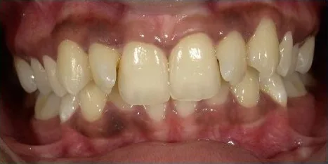 Fastbraces case 9 before treatment