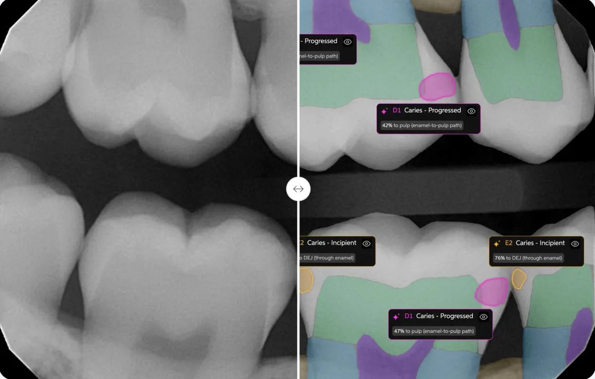 AI-enhanced dental X-ray diagnostic comparison showing detected cavities