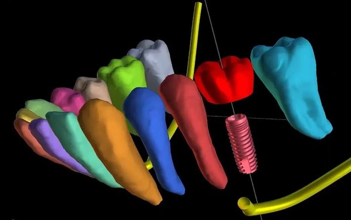 3D digital model of teeth and a dental implant used for AI-assisted treatment planning