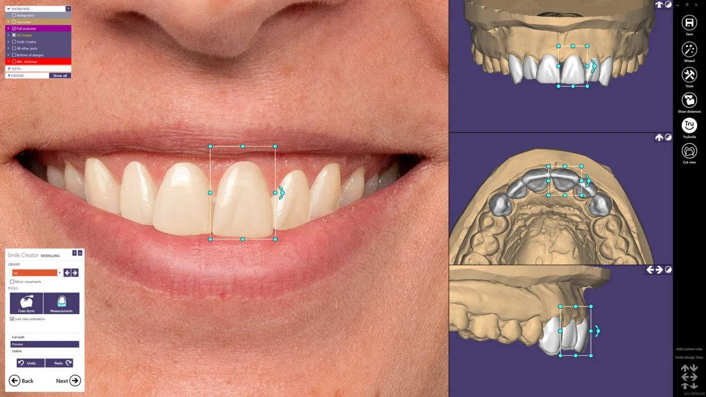 3Shape Digital Smile Design® + EXOCAD®